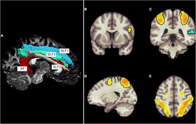 Visual Attention and Poor Sleep Quality